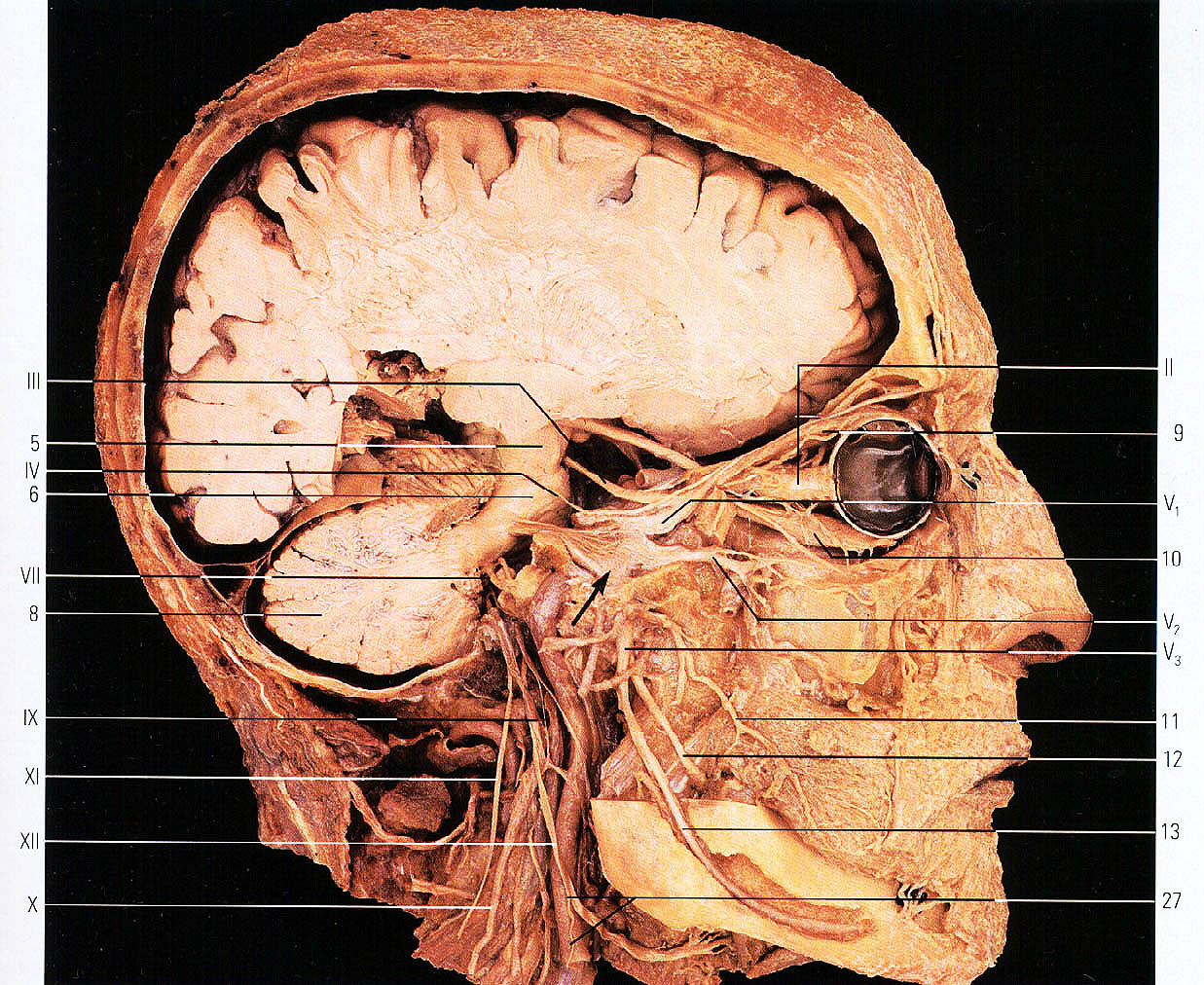 Мозги в черепной коробке. Топография головы Черепные нервы.. Анатомия черепа Сагиттальный срез. Черепно мозговые нервы кости черепа. Сагиттальный распил черепа анатомия.