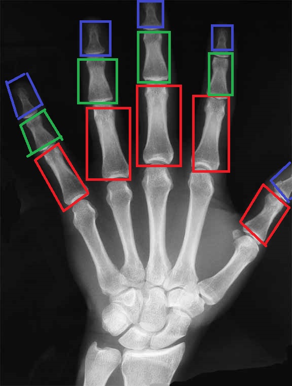 Трещина фаланги. Перелом 3 фаланги среднего пальца правой руки рентген. Остеоэпифизеолиз основания 1 пястной кости левой кисти. Перелом фаланги 3 пальца руки на рентгене. Перелом прокчимальной фплангм кичти.